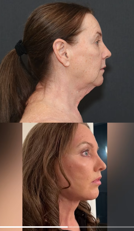 Vues de profil montrant les résultats du lifting plan profond et du lifting du cou de Tina Heaton, partagés par le Dr Mike Nayak en réponse à l'incrédulité en ligne. | Source : TikTok/nayakplasticsurgery