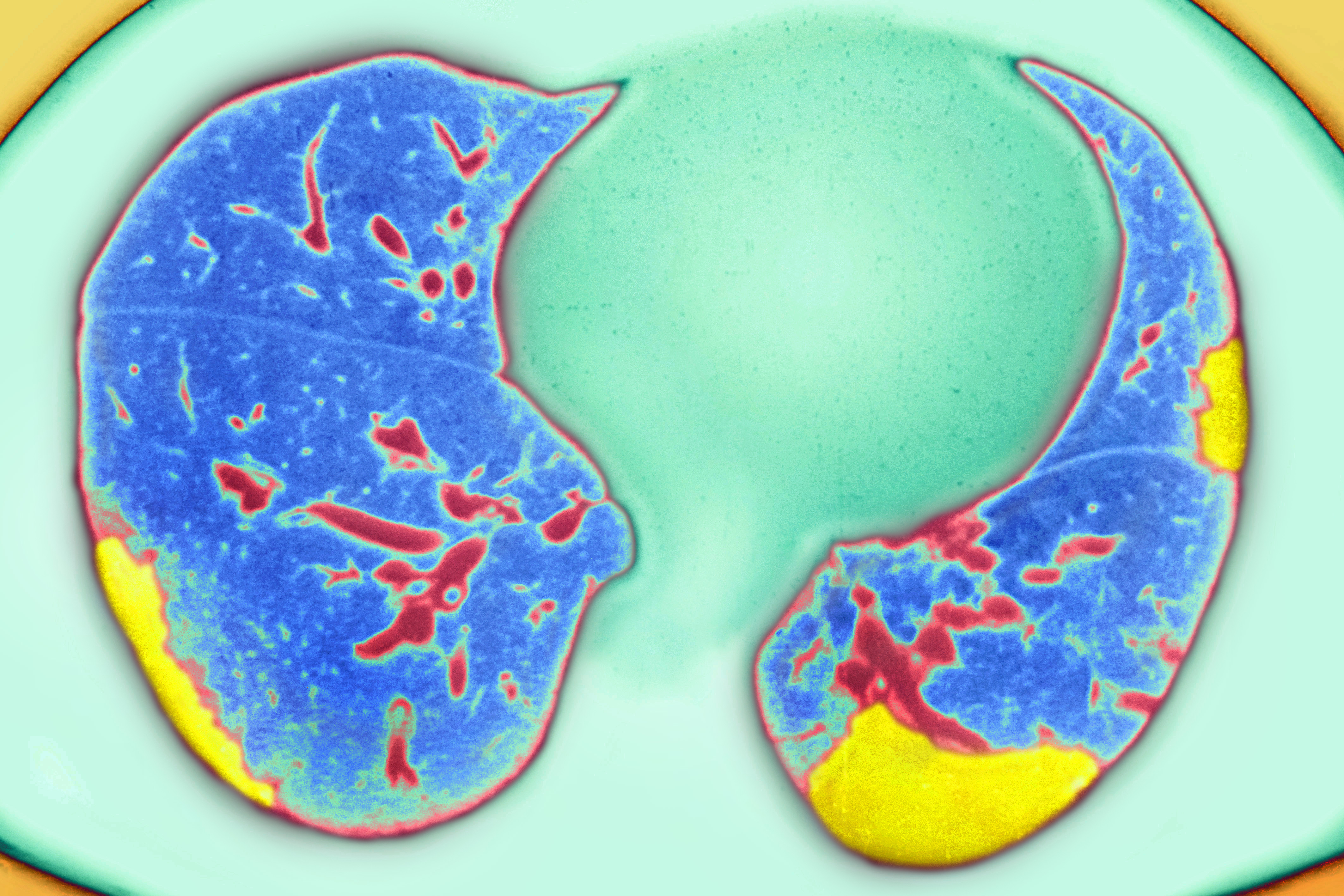 Embolie pulmonaire observée sur un scanner thoracique en coupe radiale. | Source : Getty Images