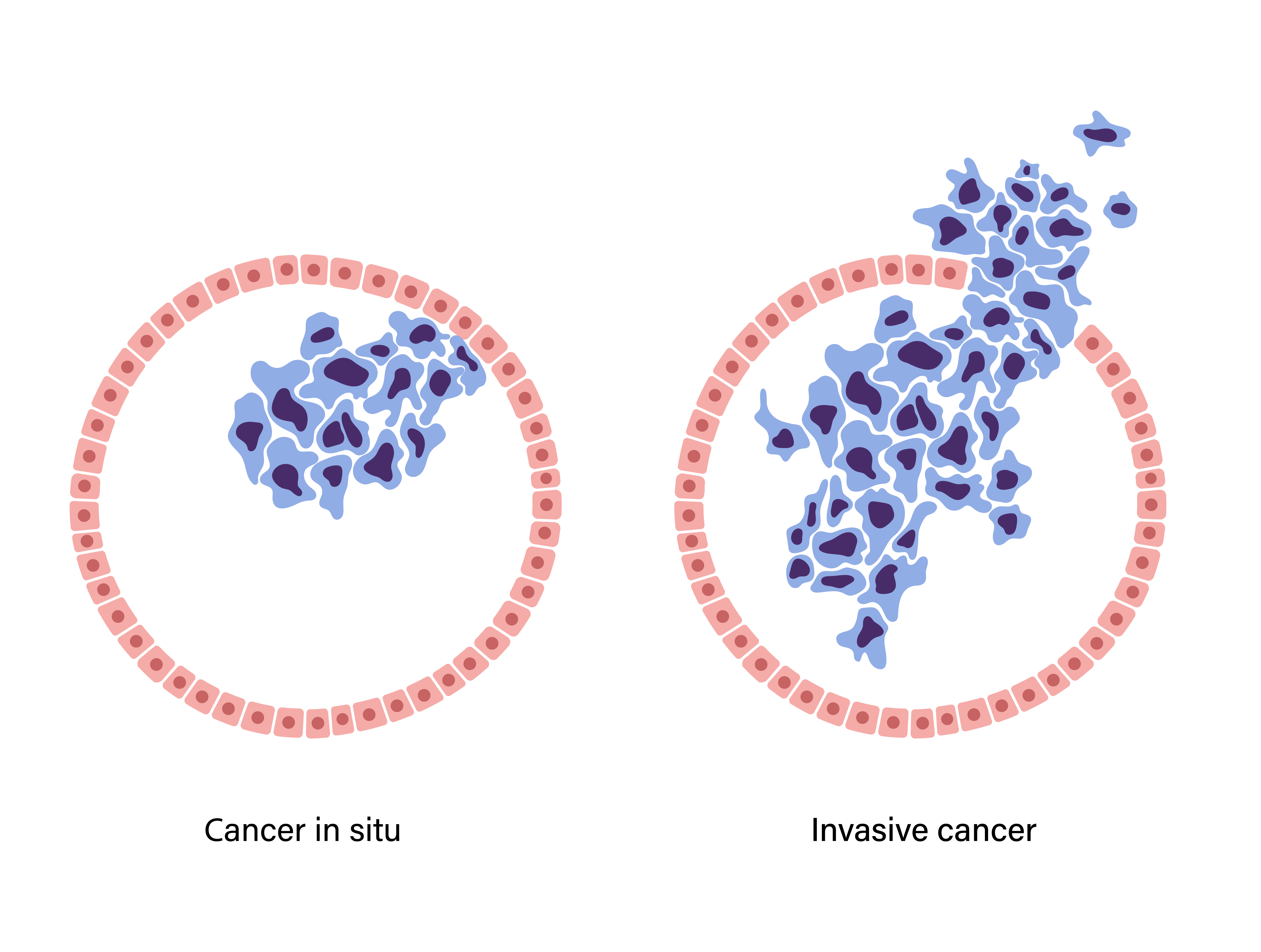 Représentation visuelle de la façon dont les cellules du cancer du sein se forment et se propagent dans le tissu mammaire | Source : Getty Images