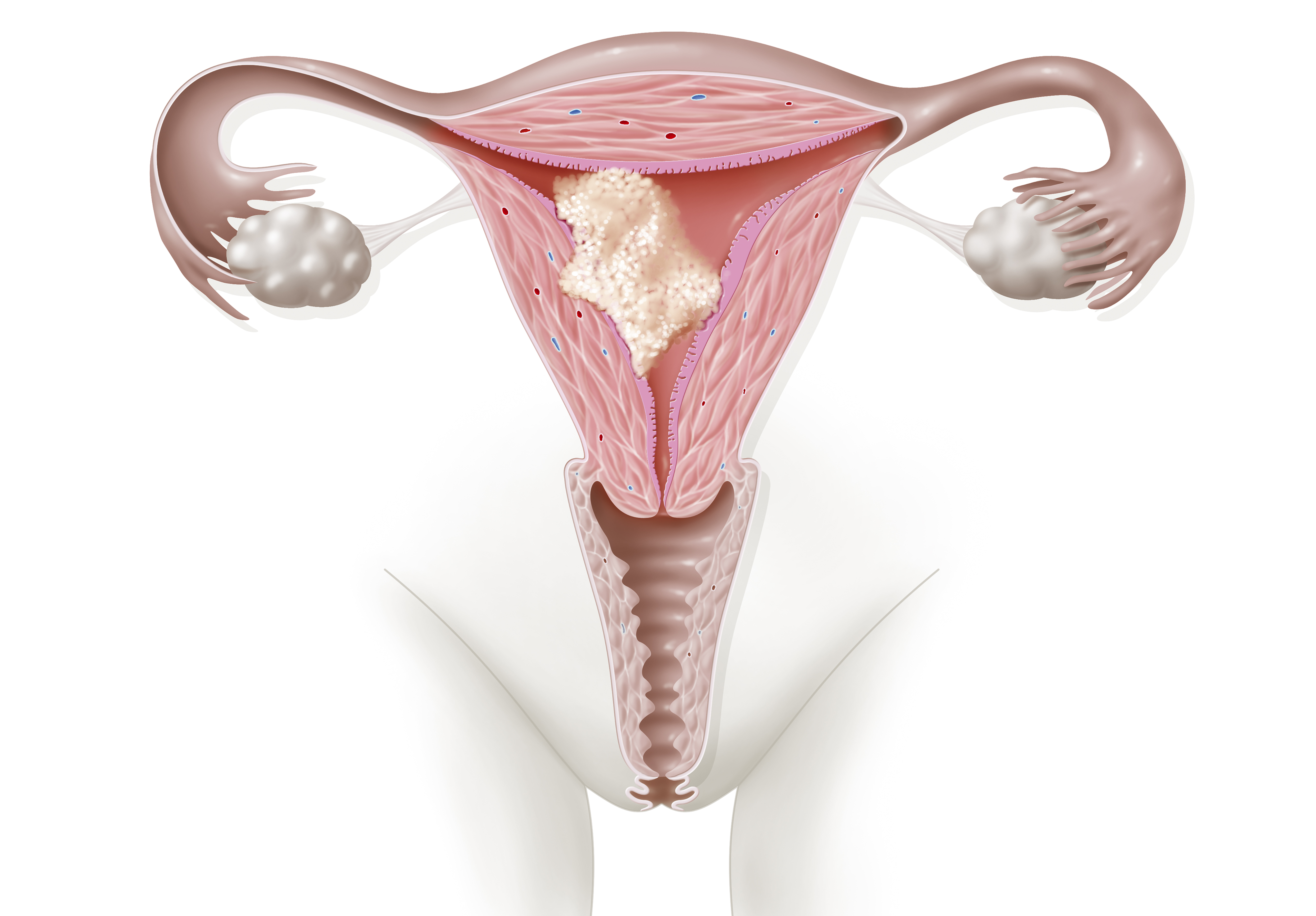 Illustration du cancer de l'endomètre (utérin) montrant une tumeur qui s'est propagée dans le muscle utérin mais qui n'a pas encore atteint le col de l'utérus. | Source : Getty Images