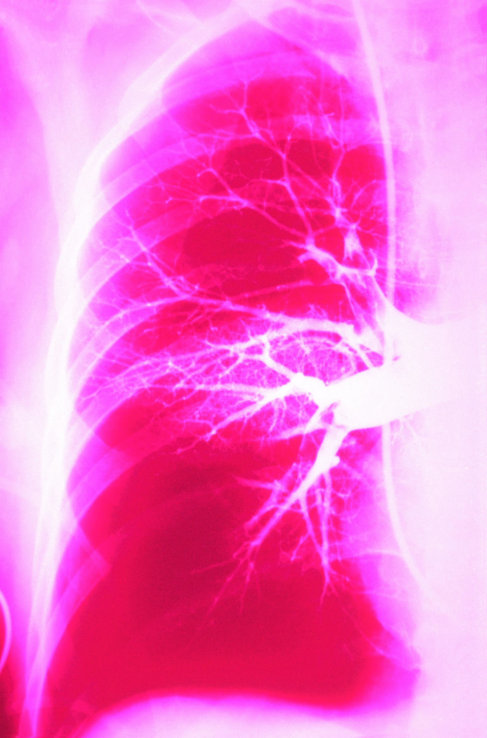 Embolie pulmonaire montrée sur une radiographie thoracique. Cette affection survient lorsqu'un caillot de sang bloque l'artère pulmonaire, souvent à partir d'une thrombose veineuse profonde dans les jambes ou le bassin. | Source : Getty Images