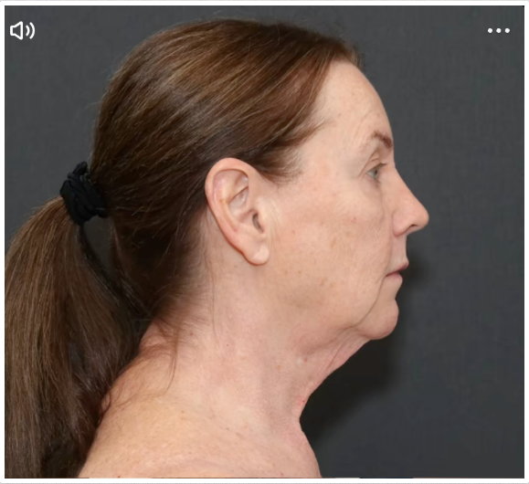 Tina Heaton avant l'opération, avec un relâchement de la peau visible le long du cou et de la mâchoire. | Source : TikTok/nayakplasticsurgery