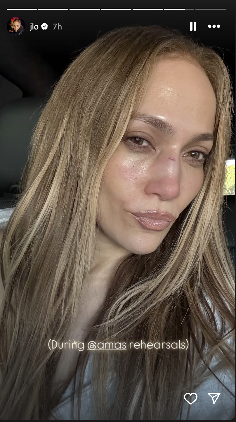 Jennifer Lopez avec une coupure sur l'arête de son nez, postée sur ses stories Instagram le 13 mai 2025 | Source : Instagram/jlo