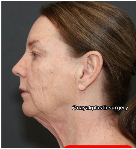 Un autre angle avant l'opération montrant la laxité de la peau du visage de Tina Heaton et la formation de bajoues. | Source : TikTok/nayakplasticsurgery