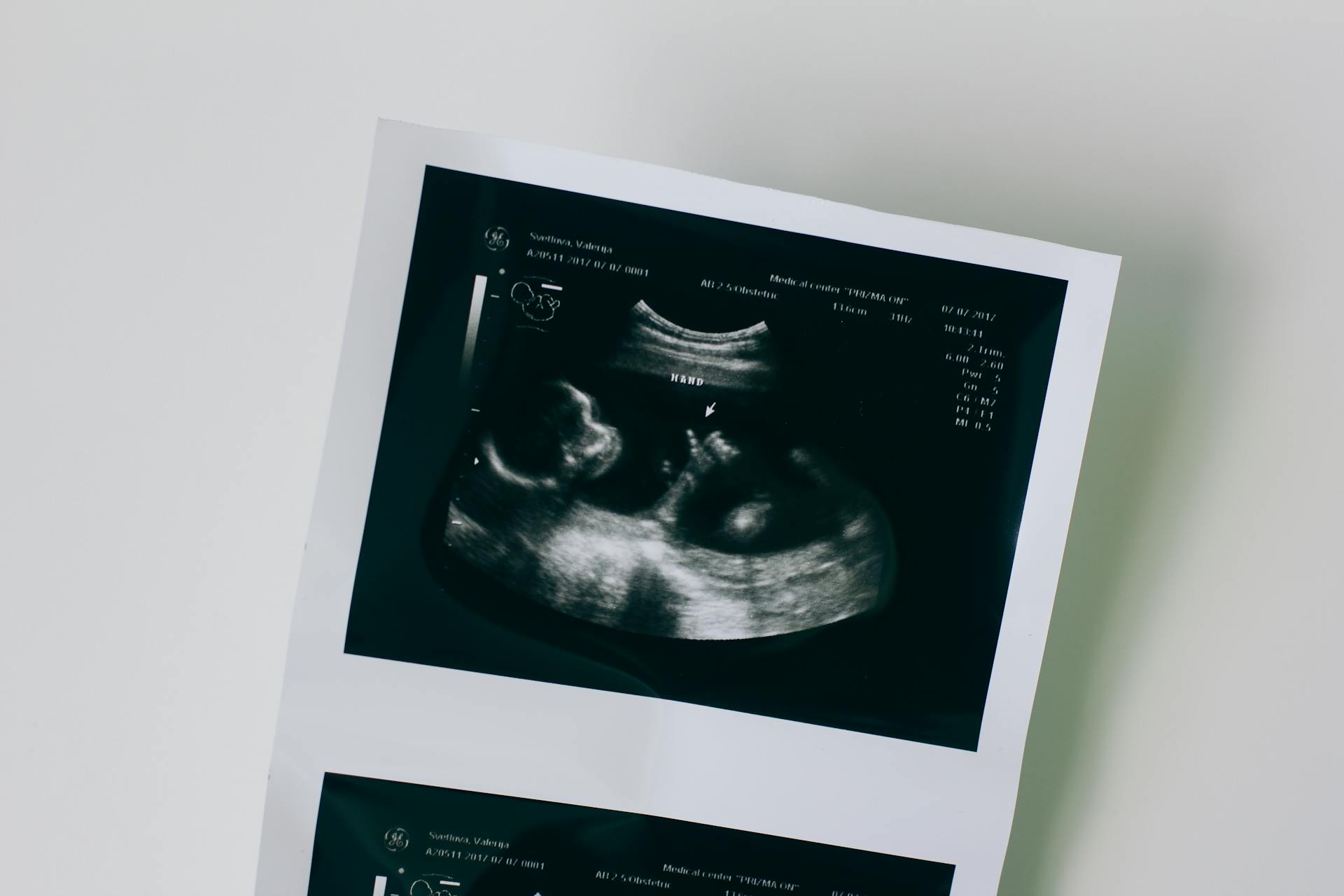 Gros plan sur une échographie | Source : Pexels