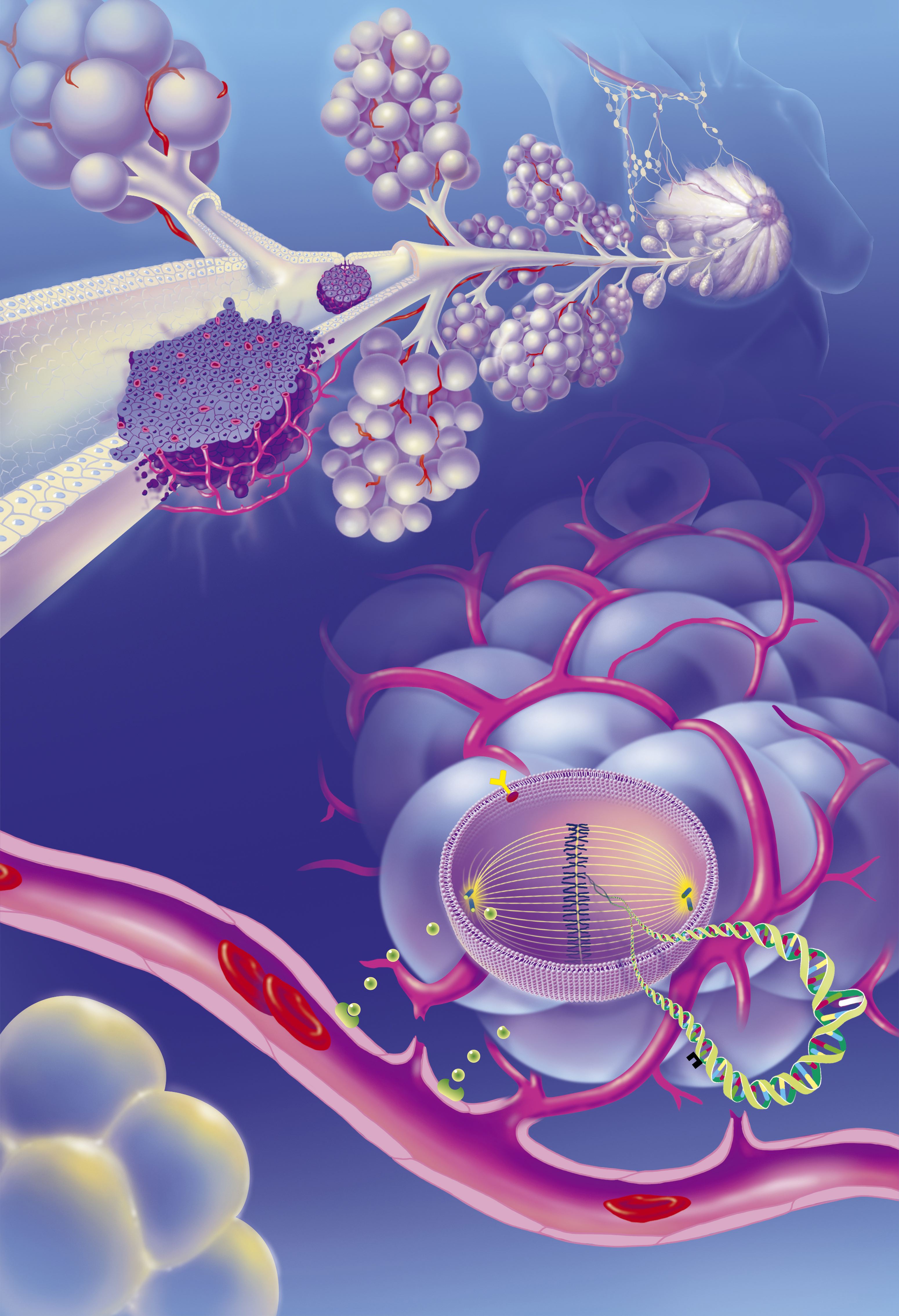 Illustration médicale montrant des carcinomes canalaires invasifs et in situ. L'image trace un zoom de la glande mammaire au canal lactifère, mettant en évidence les emplacements des tumeurs, la structure glandulaire et les ganglions lymphatiques axillaires | Source : Getty Images