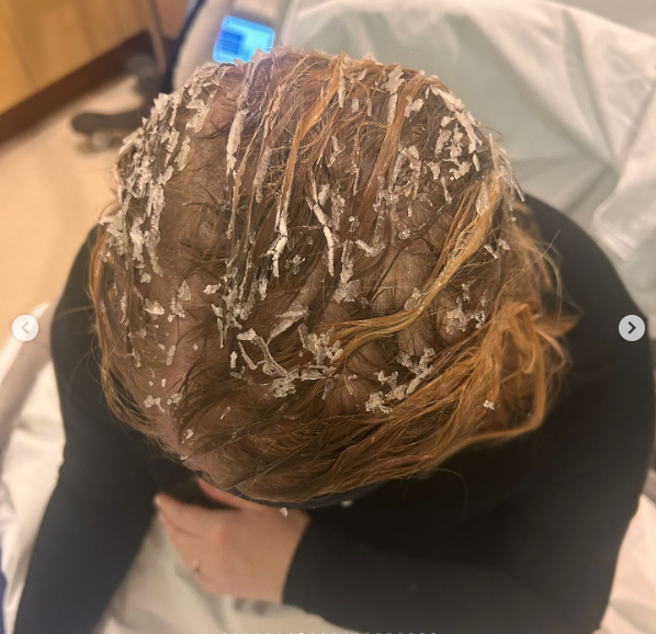Les cheveux de Morgan McGlynn Carr pendant le traitement, en date du 2 juillet 2025 | Source : Instagram/morgancheeses
