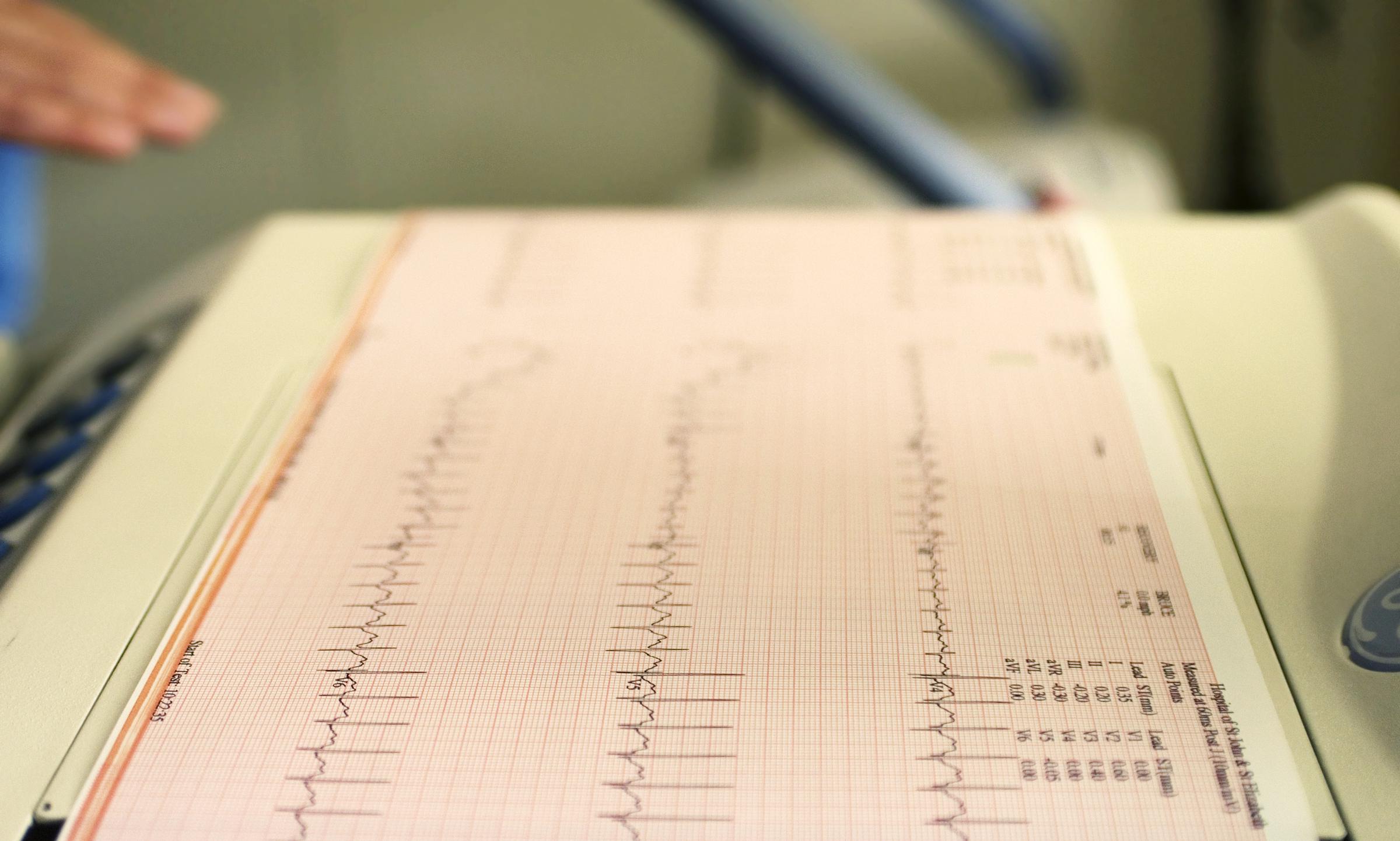 Enregistrement du cycle cardiaque d'un patient produit par un électrocardiographe | Source : Getty Images