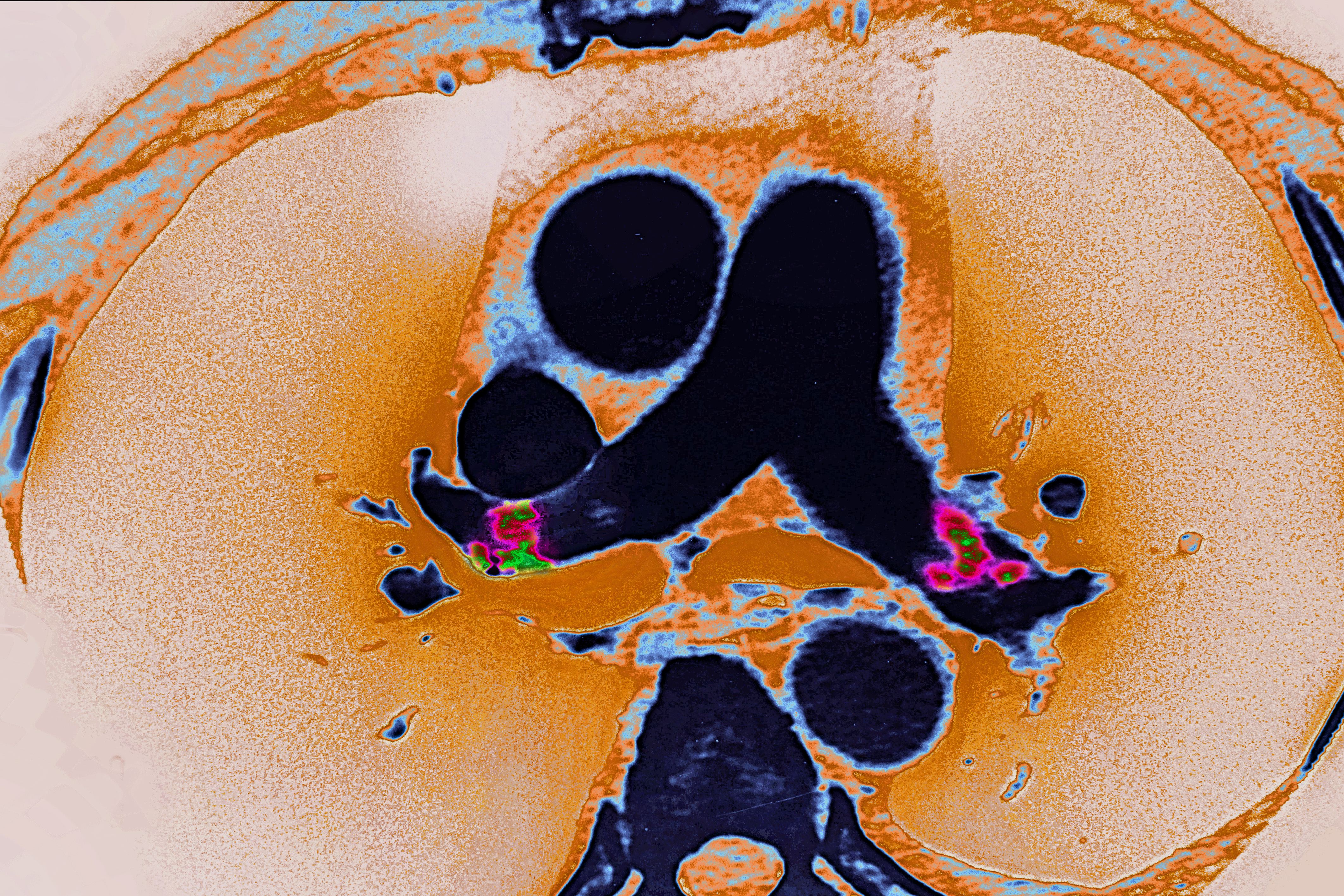 Embolie pulmonaire dans les artères pulmonaires gauche et droite, vue sur un scanner thoracique à section radiale. | Source : Getty Images