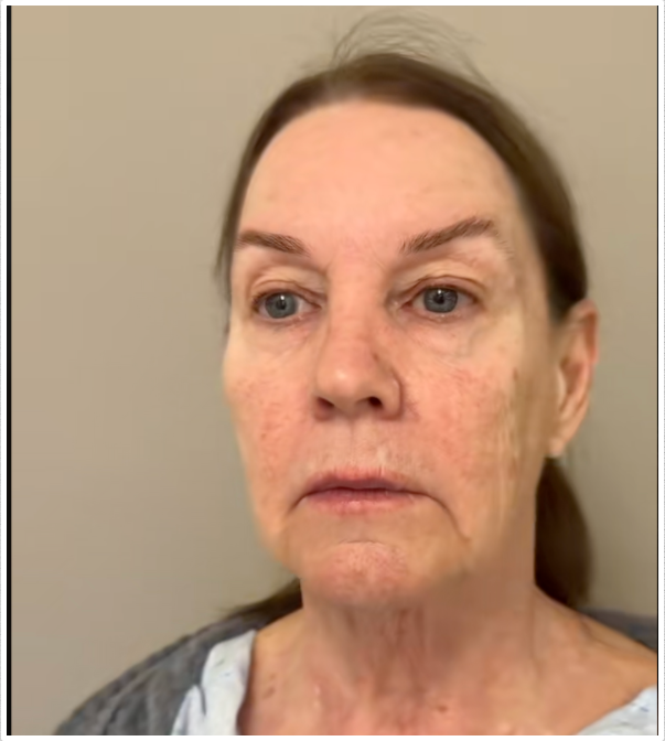 Tina Heaton, avant la chirurgie, montrant une perte de volume visible du visage et les premiers signes de vieillissement. | Source : TikTok/nayakplasticsurgery
