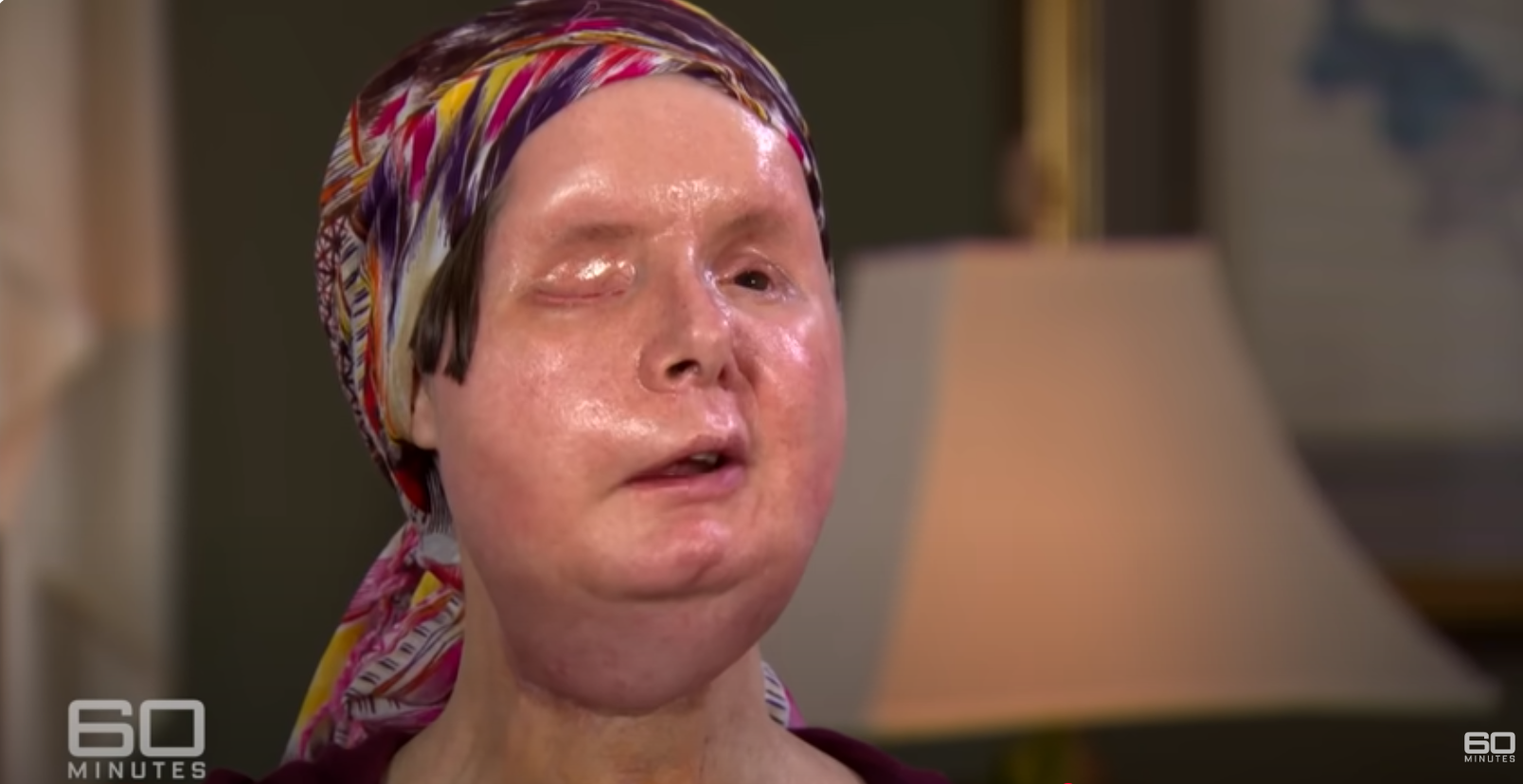 Charla Nash après l'attaque macabre du chimpanzé domestique de Sandra Herold, en date du 11 juin 2025 | Source : YouTube/60MinutesAustralia