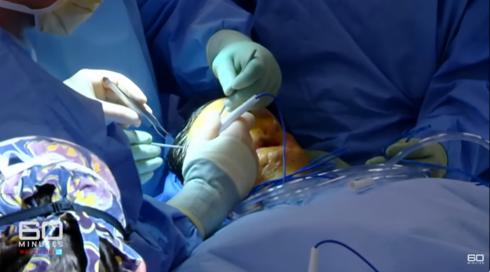 Une équipe de chirurgiens travaillant sur Charla Nash lors de son opération de greffe de visage, datée du 11 juin 2025 | Source : YouTube/60MinutesAustralia