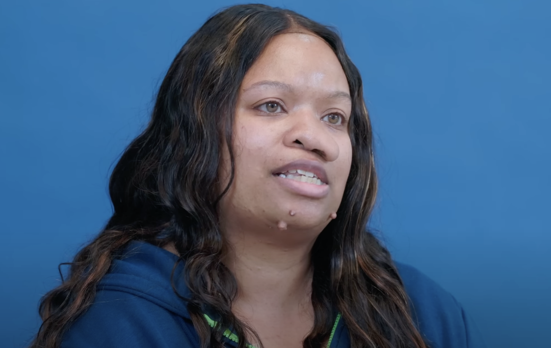 Danielle avant l'opération, en date du 2 août 2024 | Source : YouTube/@Dr.Truesdale