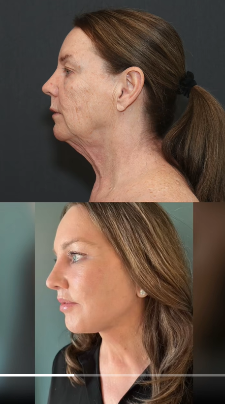 Comparaison du profil avant et après de Tina Heaton, partagée par le Dr Mike Nayak pour répondre au scepticisme du public quant à l'authenticité de sa transformation. | Source : TikTok/nayakplasticsurgery